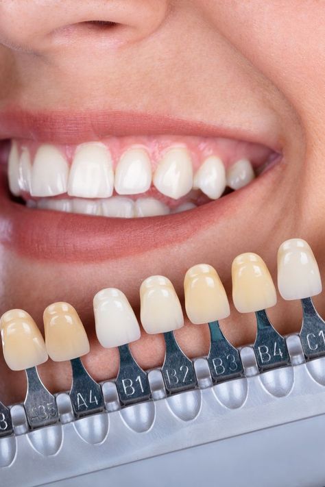 Whiten Your Teeth At Home, Teeth Whiting At Home, Dental Advertising, Dental Studio, Tooth Decay Remedies, Remedies For Tooth Ache, Whiten Your Teeth, Perfect Teeth, Teeth Health