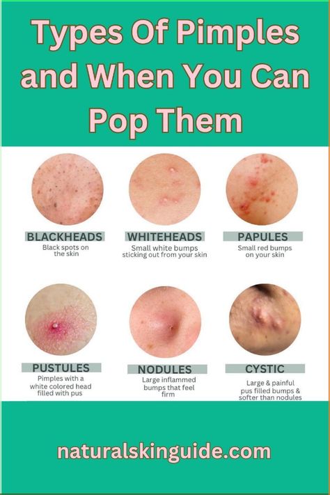 Wondering when and how to best pop a pimple? Wonder no more! We've got the pimple poppin' guide you didn't know you needed. Pimple Location Meaning, How To Avoid Pimples, Underground Pimple, How To Treat Pimples, What Causes Pimples, Cystic Pimple, Home Remedies For Pimples, How To Get Rid Of Pimples, How To Remove Pimples