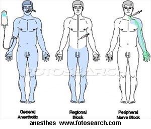 Local Anesthesia, General Anesthesia, Nurse Anesthesia, Veterinary Tech, Aa School, Nclex Review, General Anaesthesia, Nurse Anesthetist, Nursing Mnemonics