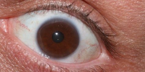 What Causes Bulging Eyes Bulging Eyes, Graves Disease, Comb Over, Natural Supplements, Autoimmune Disease, Muscles, Disease