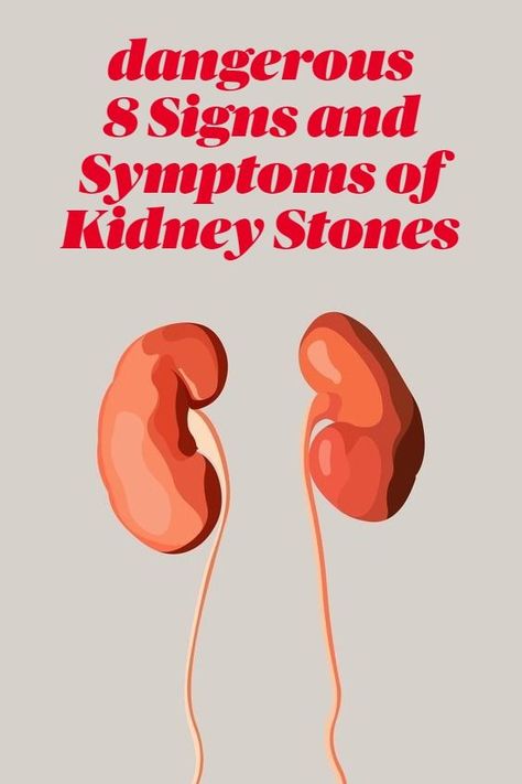 8 Signs and Symptoms of Kidney Stones Kidney stones are hard collections of salt and minerals often made up of calcium or uric acid. They form inside the kidney and can travel to other parts of the urinary tract. Stones vary in size. Some are as small as the period at the end of this sentence — a fraction of an inch. Others can grow to a few inches across. Some kidney stones can become so large they take up the entire kidney. Kidney Stone Symptoms, Cloudy Urine, Kidney Symptoms, Kidney Pain, Need To Pee, Health Communication, Turmeric Vitamins, Kidney Stone, Lower Back Pain Exercises