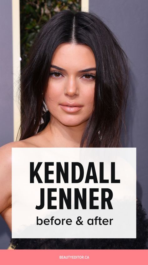 Kardashians Before And After Surgery, Kendall Jenner Before And After Surgery, Kendall Jenner Before And After, Kylie Jenner Before And After, Kendall Jenner Nose, Kybella Before And After, Kendall Jenner New Hair, Kardashians Before And After, Khloe Before And After