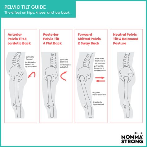 Sway Back Posture, Side Planks, Basic Anatomy, Sway Back, Ballet Moves, Pelvic Tilt, New Status, Human Anatomy And Physiology, Tilt Shift