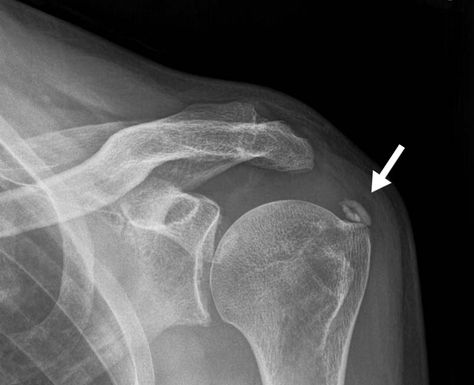 Calcium Deposits (Calcification): Types, Causes & Risks Calcium Deposits, Rare Genetic Disorders, Ligament Tear, Frozen Shoulder, Hormone Replacement, Physical Therapy Exercises, Genetic Disorders, Tennis Elbow, Body Tissues