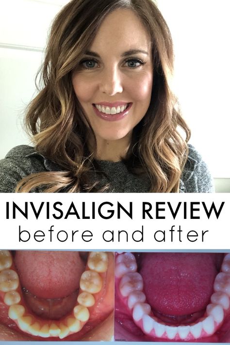 Invisalign Review on SixSistersStuff.com - the before and after, plus everything you need to know #invisalign #orthodontist #adultbraces @DefayOrthodontics Invisaline Before And After, Clear Aligners Before And After, Braces Vs Invisalign, Byte Aligners Before And After, Invisalign Tips And Tricks, Mewing Before And After, Invisalign Before And After, Before And After Invisalign, Invisalign Aesthetic