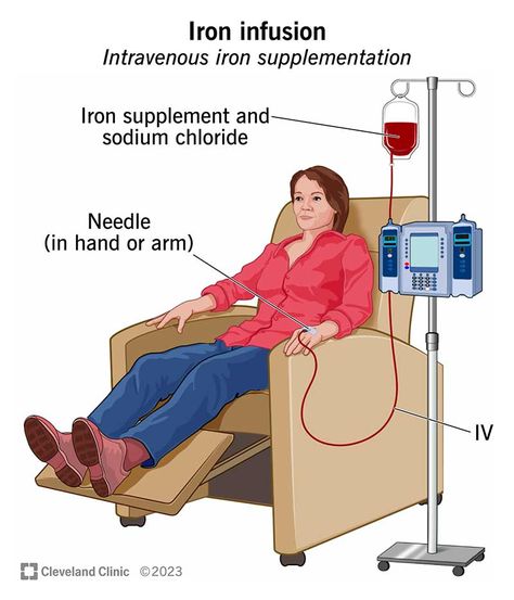 Iron Infusion Side Effects, Iron Infusion, Fast Heartbeat, Good Sources Of Iron, Tuna And Egg, Iron Supplement, Iron Deficiency, Low Blood Pressure, Cleveland Clinic