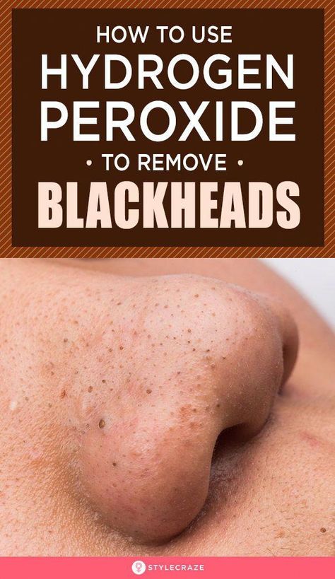 Mascara Hacks, To Remove Blackheads, Blackhead Mask, Home Remedy For Cough, Cold Sores Remedies, Remove Blackheads, Get Rid Of Blackheads, Natural Cough Remedies, Cold Sore