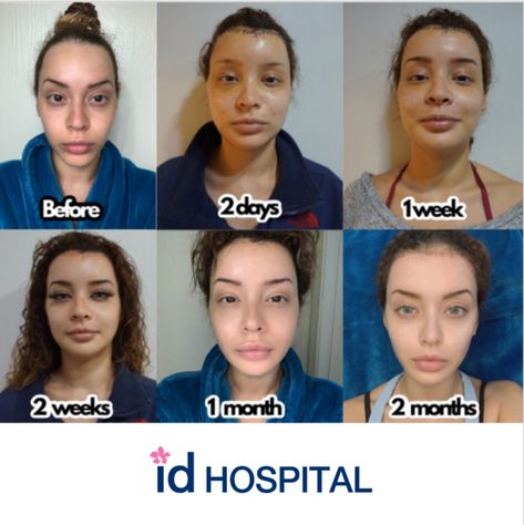 This is a recovery process after plastic surgery in ID Hospital, Korea. Remember that the final result will be seen within 6 months - 1 year ✨ #vline #vlinerecovery #plasticsurgeryrecovery #vline #vlinekorea #foreheadreduction #hairlinelowering #lifting #v3lifting #beforeafter #idhospital #transformation #transformationpic #idhospitalkoreabeforeafter Best Plastic Surgery Before And After, Vline Surgery Before And After, Id Hospital Korea, South Korean Plastic Surgery, Plastic Surgery Recovery, Forehead Reduction, Rhinoplasty Recovery, Face Plastic Surgery, Nose Surgery Rhinoplasty