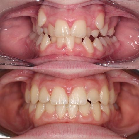 Check out this 15year old female’s transformation! ⠀⠀⠀⠀⠀⠀⠀⠀⠀ Our orthodontics is comprehensive. We don’t just look at aesthetics but functionality too. ⠀⠀⠀⠀⠀⠀⠀⠀⠀ When she came into see Dr.Ng she presented with: -Extremely crowded teeth -Buccally impacted canines -Bilateral crossbite ⠀⠀⠀⠀⠀⠀⠀⠀⠀ After only 15 months of braces she now has: -Improved functionality for chewing -Broader arches -Beautiful straight teeth ⠀⠀⠀⠀⠀⠀⠀⠀⠀ *All accomplished WITHOUT extractions or surgery!* ⠀⠀⠀⠀⠀⠀⠀⠀⠀ If you want t Teeth Implants Before And After, Messed Up Teeth, Crowding Teeth, Teeth Reference, Braces Before And After, Rotten Teeth, Dental World, Skull Reference, Crooked Teeth