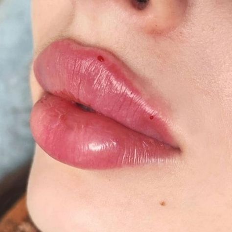 Lips Fillers, Lips Inspiration, Face Fillers, Botox Lips, Cheek Fillers, Perfect Nose, Lip Filler, Lip Shapes, Cute Makeup Looks