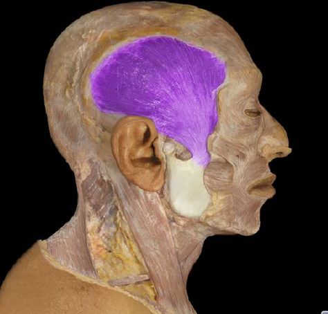 Fact of the Day: Temporalis is one of the muscles of mastication - its function is necessary for you to be able to chew your food. Originating at the temporal lines on the parietal bone of the skull and inserting on the coronoid process of the mandible, it is responsible for elevating the mandible; raising the lower jaw. (Photograph via Grace Mohgan) ~~ www.facebook.com/TheIrregularAnatomist ~~ www.twitter.com/Irr_Anatomist Temporalis Muscle, Platysma Muscle, Head Anatomy, Fact Of The Day, Medical Anatomy, Anatomy For Artists, Medical Science, Human Anatomy, Muscles