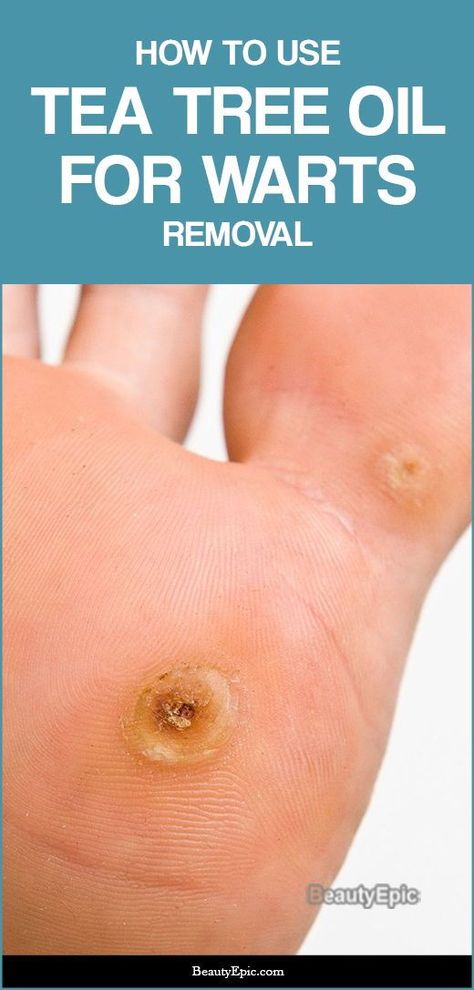 Warts Removal, What Causes Warts, Warts On Hands, Warts On Face, Home Remedies For Warts, Warts Remedy, Get Rid Of Warts, Cold Sores Remedies, Natural Sleep Remedies