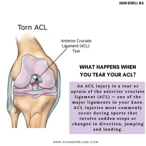 Knee Pain Stretches, Acl Recovery, Acl Injury, Knee Pain Remedy, My Knee Hurts, Swollen Knee, Anterior Cruciate Ligament, Knee Pain Exercises, Acl Tear