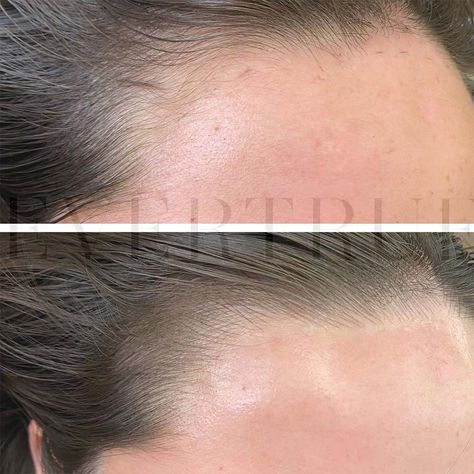 Hairline Tattoo - Cosmetic Tattoo for a Receding Hairline Hair Line Tattoo, Hairline Reduction Surgery, Lashline Enhancement Tattoo, How To Fix A Receding Hairline, Hairline Tattoo, Camouflage Tattoo, Hair Pigmentation, Hairline Transplant, Thinning Hairline