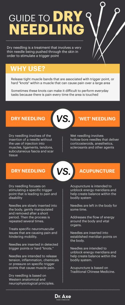 Guide to dry needling - Dr. Axe Meme Spiderman, Needling Therapy, Dry Needling Therapy, Acupressure Headache, Punkty Spustowe, Tmj Relief, Acupuncture Needle, Sports Physical Therapy, Referred Pain