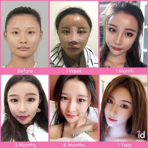 South Korean Plastic Surgery, Cheekbone Reduction, Kpop Plastic Surgery, Jaw Reduction Surgery, Forehead Reduction, Face Plastic Surgery, Change Appearance, V Line Surgery, Nose Fillers