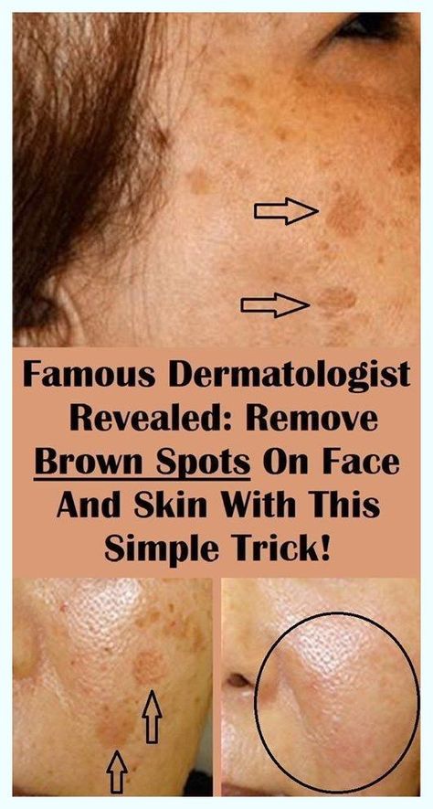 I really appreciate it. Extraordinary detail! Remove Age Spots, Age Spots On Hands, Brown Age Spots, Brown Spots On Skin, Spots On Skin, Healthy Face, Dark Spots On Face, Brown Spots Removal, Brown Spots On Face