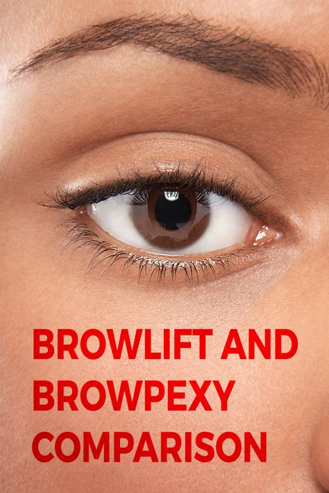 Many people have heard of a brow lift, but not browpexy. Though they sound similar, the two procedures are not the same.  A brow lift is used to reposition the skin and soft tissues of the forehead and brow to diminish forehead wrinkles and sagging of the brow.  Creases and furrows between eyebrows can also be addressed with a brow lift.  Browpexy simply raises the patient’s eyebrows to make them more aesthetically pleasing, but has no effect on the forehead. Brow Lift Before And After, Endoscopic Brow Lift, Brow Lift Surgery, Smokers Lines, Forehead Lift, Face Surgery, Eyebrow Lift, Wrinkle Remedies, Thick Brows