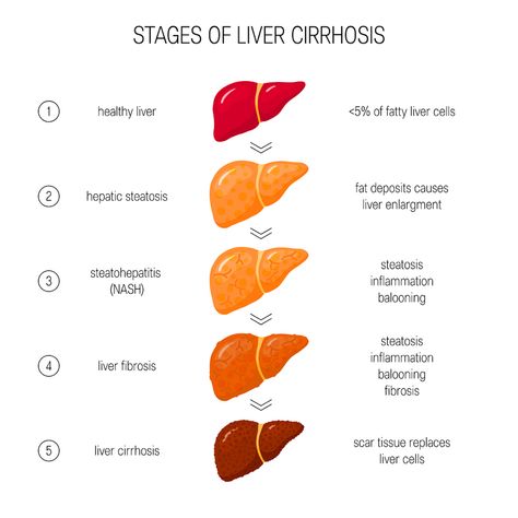 Did you know the liver is the 2nd largest organ in the human body?  Second only to your skin.  Take care of your liver and it will take care of you. Medical Things, Human Liver, Liver Failure, Before Sleep, The Liver, Nutrition Coach, The Human Body, Natural Remedies, Your Skin