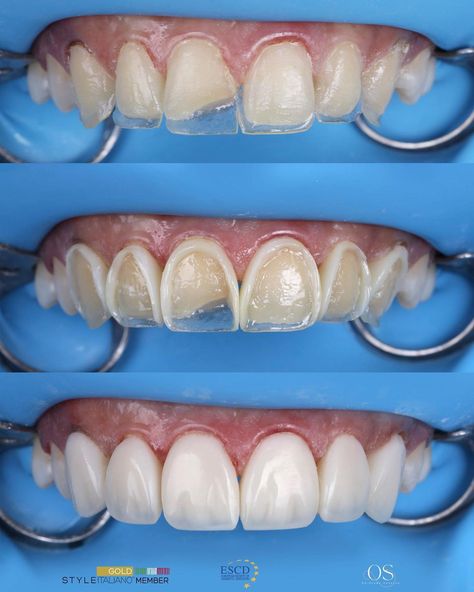 Dr.Osama Shaalan | Free hand palatal shell , unica frame before and after layering the veneering layer . Polished by lucida WDB composite ,SI2 + E +MP… | Instagram Teeth Makeover, Naturally Whiten Teeth, Dental Images, Composite Veneers, Remedies For Tooth Ache, Dental Aesthetics, Dental Videos, Dental Fun, Aesthetic Dentistry