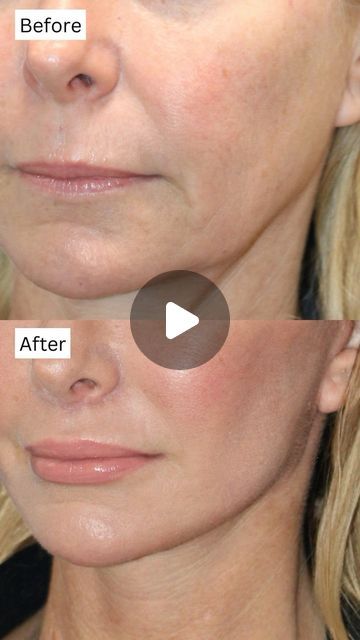 748K views · 22K likes | Amir M Karam, MD on Instagram: "I mean talk about a jaw dropping transformation! Wait until the end for a close up comparison of the jawline before and after. Truly so insane! Who wouldn’t kill for that jawline at any age 😂

She’s only two weeks out in these photos, and her incisions are still healing along with some other areas. But you can already see the architecture of her face has been restored to a beautiful youthful shape. 

At two weeks and 51 years old, she looks incredibly natural, just like her younger self.⁠
⁠
To achieve these incredible results, we performed: ⁠
✅Vertical Restore⁠
✅Custom Fat Transfer⁠
✅Lower Blepharoplasty⁠
✅Lip Lift⁠
✅@Karammdskin Trifecta for 6 months to address skin concerns prior to surgery⁠
.⁠
.⁠
.⁠
Let me know what you think and Jaw Excersises Before And After, Jaw Surgery Before And After, Jawzrsize Before And After, Jaw Surgery Before And After Overbite, Corrective Jaw Surgery, Still Healing, Lip Lift, Old Photo Restoration, Fat Transfer