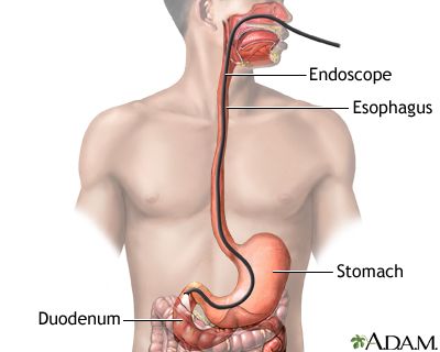 Esophagogastroduodenoscopy (EGD) Endoscopy Procedure, Small Intestine, Surgical Tech, Stomach Ulcers, Med Surg, Gi Tract, Family Medicine, Abdominal Pain, Acid Reflux