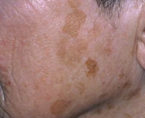 Lentigos (liver spot/age spot) Get Rid Of Age Spots, Liver Spot, Age Spots On Face, Vaseline Beauty Tips, Age Spot, Hyper Pigmentation, Sun Damaged Skin, Skin Care Wrinkles, Spots On Face