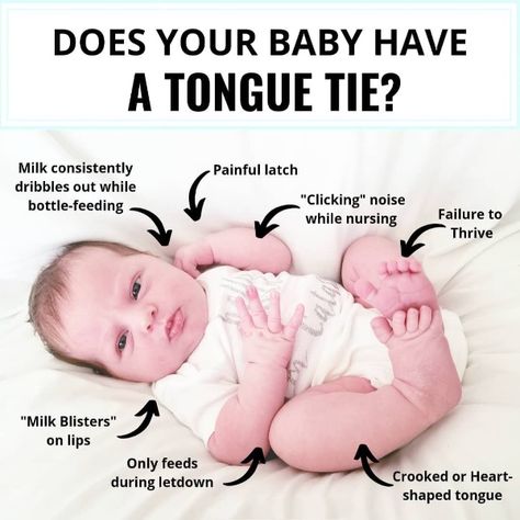 Tongue tie is a tricky ailment to diagnose.
.
Some babies display all of these symptoms, others display none. Some babies don’t have any issues with their tongue tie, while others have severe breastfeeding problems.
.
The newborn in this picture is actual Lil’ C, just a few days after she was born. If you look closely, you can see the blisters on her lips, “milk blisters.” Milk Blister, Blister On Lip, Tongue Tie, Baby Care Tips, Baby Health, Bottle Feeding, Baby Care, Care Tips, Girl Outfits