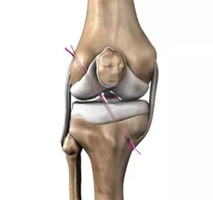 ACL Reconstructive Surgery Houston, Cypress, & Beaumont, TX Knee Ligament Injury, Torn Acl, Knee Ligaments, Acl Surgery, Anterior Cruciate Ligament, General Anaesthesia, Ligament Tear, Acl Tear, Leg Bones