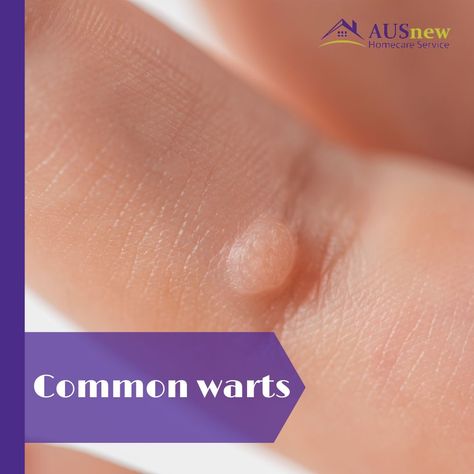 🌟Common warts are tiny, granular skin growths that mostly affect the hands and fingers of the affected person. Common warts are rough to the touch and frequently have a pattern of tiny black dots, which are microscopic blood vessels that have gotten clogged. 🌟Common warts are spread by touch and are caused by a virus. After your skin is exposed to the virus, it may take a wart two to six months to appear. Common warts are mostly benign and go away on their own. How To Get Rid Of Warts On Fingers, How To Get Rid Of Warts On Face, How To Get Rid Of A Wart On Your Finger, How To Get Rid Of Warts On Hands, Warts How To Get Rid Of, Planters Wart, What Causes Warts, Natural Wart Remedies, Wart On Finger