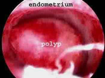 Hysteroscopy Uterine Polyps, Endometrial Polyps, Fertility Clinic, Ivf Clinic, Fertility, Too Much, Baby Stuff, Health