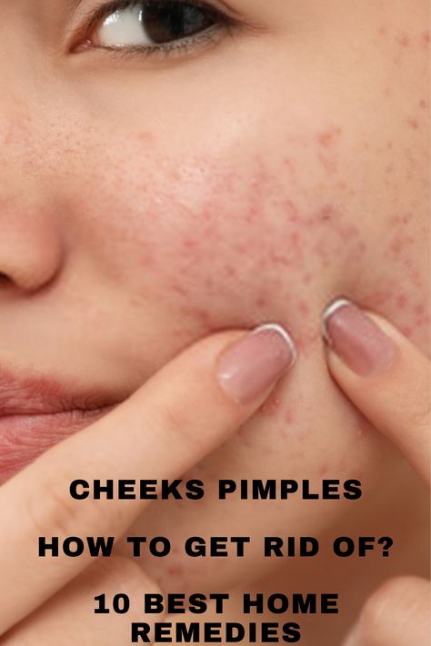 Cheek Breakouts, Cheek Pimples, Pimple Under The Skin, How To Treat Pimples, Remedies For Pimples, Cheek Acne, Home Remedies For Pimples, Blind Pimple, Get Rid Of Pimples