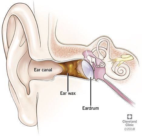 Swimmers Ear Remedy, Impacted Ear Wax, Ear Wax Buildup, Swimmers Ear, Ear Canal, Human Ear, Hearing Health, Ear Health, Ear Wax Removal