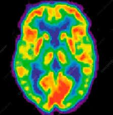 PET scan of a normal brain - Stock Image - C005/1680 - Science Photo Library Increase Memory, Pet Scan, Benefits Of Sleep, Brain Scan, Healthy Brain, Brain Food, Improve Memory, Healthy Sleep, Memory Games