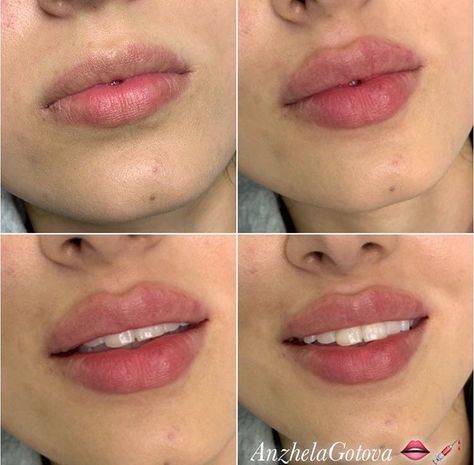 0.5 Ml Lip Filler Before And After, Desired Lips, Heart Shaped Lips, Lips Inspiration, Botox Lips, Face Mask Aesthetic, Facial Fillers, Facial Contouring, Plump Lips