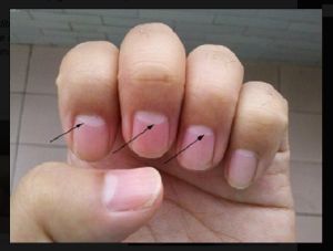 Moons On Fingernails, Moon Meaning, Look At The Moon, Nail Health, Business Networking, Low Energy, Reflexology, Health Info, Health Problems