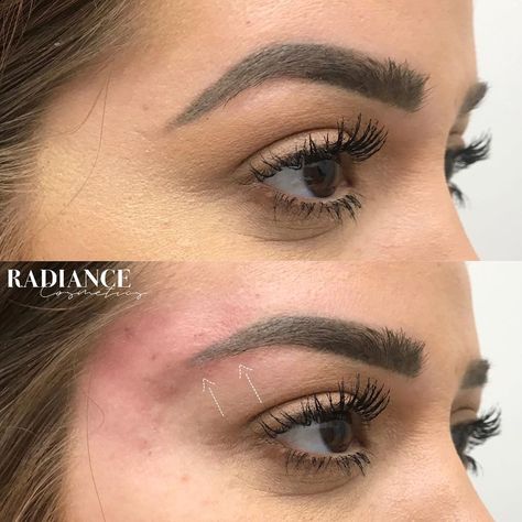 Upper Eyelid Filler, Fox Eye Surgery, Beauty Technician, Brow Lift Surgery, Jaw Reduction Surgery, Cosmetic Nurse, Aesthetic Procedures, Face Surgery, Plastic Surgery Gone Wrong