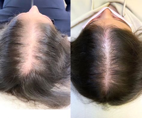 Hair Regrowth Before And After, Hair Prp Before And After, Hair Growth Before And After, Prp For Hair, Hair Ext, Prp Hair, Hair Facts, Hair Repair Treatments, Hair Therapy