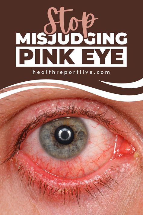 Here is a close up of a persons eye with the words stop missuding pink eye Burning Eyes Relief Remedies, Viral Pink Eye Remedy, Pink Eye Relief, How To Get Rid Of Pink Eye Fast, Pink Eye Remedies, Pink Eye Remedy, Pink Eye Home Remedies, Natural Pink Eye Remedy, Aloe Vera For Sunburn