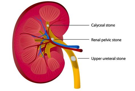 Acupressure Side Effects Kidney stones may be eliminated by combining herbs, acupuncture, and medications. - Kidney stones may be eliminated by combining herbs, acupuncture, and medications. Diy Massage Oil, Ear Seeds, Medicine Quotes, Thai Yoga Massage, Diy Massage, Massage Place, Kidney Pain, Thai Yoga, Herbal Therapy