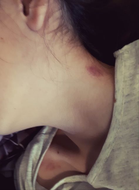 Hickies Neck And Chest, Love Bite Photos Aesthetic, Hickey Girls, Love Bites Mark Aesthetic, Love Bite Photos Real, Love Bite Snap, Hickey Mark, Neck Full Of Hickeys, Love Bite Photos