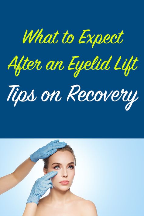 Upper Eyelid Lift Surgery, Eyelid Lift Surgery Before After, Eye Lid Surgery Before And After, Blephoraplasty Surgery, Hooded Eye Surgery, Eye Lid Surgery, Eye Lift Surgery, Plastic Surgery Recovery, Time To Heal