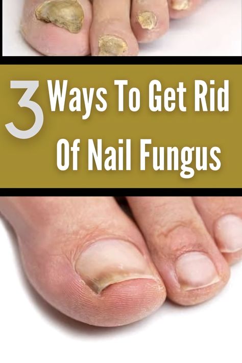 Fungal Nail Infections Toe Fungus Remedy, Nail Remedies, Natural Antifungal, Fingernail Fungus, Toenail Fungus Remedies, Nail Problems, Nail Fungus Remedy, Nail Infection, Fungal Nail