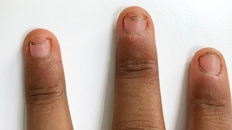 Onycholysis: Causes, Symptoms, and Treatments Bitten Nails, Fingernail Health, Nail Disorders, Nail Falling Off, Best Summer Nail Color, Lip Care Routine, English Grammar Worksheets, Nail Bed, Healing Hands