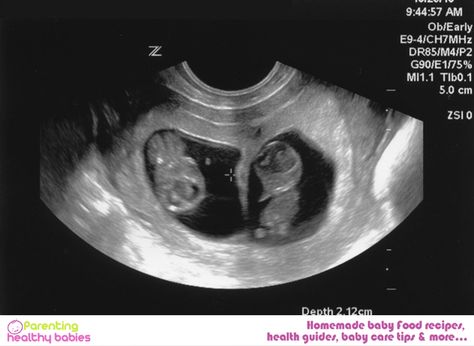 9 Weeks Pregnant Ultrasound, 9 Weeks Pregnant Symptoms, 9 Week Ultrasound, Nine Weeks Pregnant, 16 Weeks Pregnant Ultrasound, Twins Ultrasound, Pregnant Symptoms, Pregnant Ultrasound, 9 Weeks Pregnant