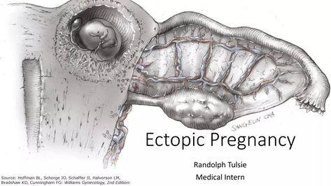 Ectopic Pregnancy Medical Intern, Spirit Baby, Pregnancy Images, Earth Baby, Ectopic Pregnancy, Mother And Father, For Free, Quick Saves