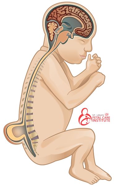 What is myelomeningocele (spina bifida)? Spina Bifida Awareness, Spina Bifida, Care Coordination, Surgery Center, Spinal Cord, Nursing Notes, Prenatal, Social Platform, Health Facts