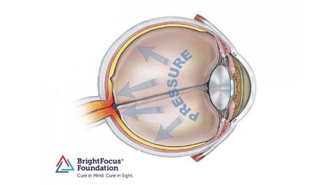 Ocular hypertension occurs when eye pressure is high but glaucoma isn't yet evident. Learn about ocular hypertension, if it has apparent symptoms, and why it's often underdiagnosed. Eye Pressure, Eye Study, Optic Nerve, Low Blood Pressure, Eye Exam, Nerve Damage, Struggle Is Real, Lower Blood Pressure, Health Conditions