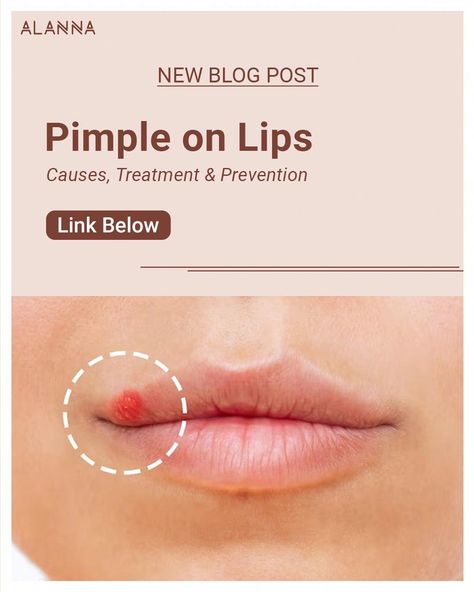 Pimples Around Lips, Pimples On Lip Line, Blister On Lip, What Causes Pimples, Lip Pimple, Zit Remedy, Inflamed Pimple, Redness Pimple, Pimple Causes