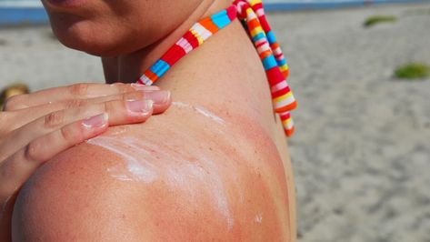 How to treat a sunburn—when your skin is red, hot, and peeling, don't just reach for the aloe. This is the right way to treat your burn. Home Remedies For Sunburn, How To Treat Sunburn, Heal Sunburn, Sunburn Remedies, Sunburn Relief, Boho Mode, Baking Soda Uses, Real Woman, Sun God